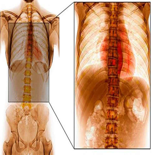 Spine tuberculosis Doctor